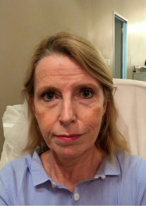 Supplied Lè Unique Ultra Laser photos. Individual results vary. — before