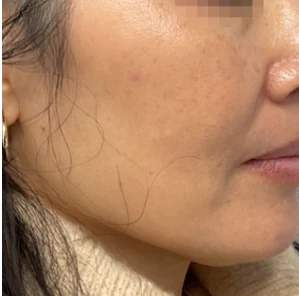 After 1 Ultra treatment — after
