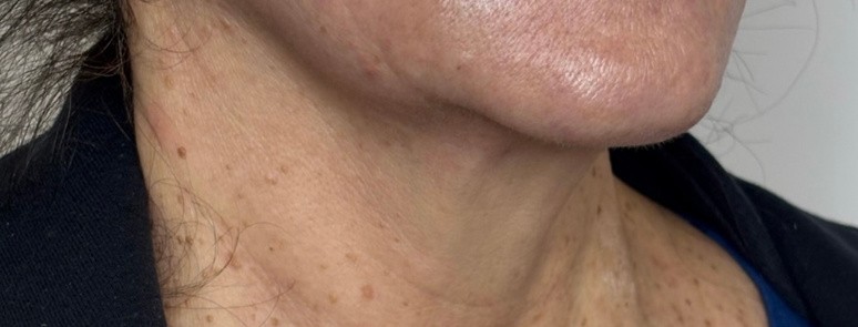 Neck & jawline — after 3 XERF treatments — after