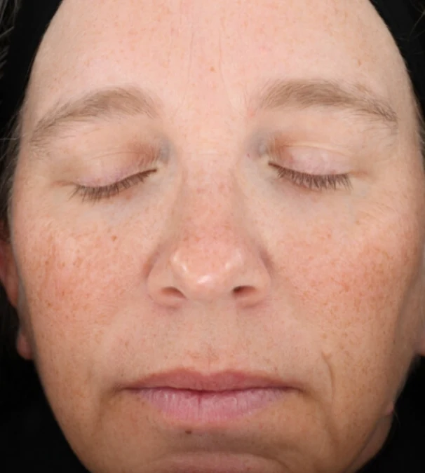 After 3 Ultra treatments — before