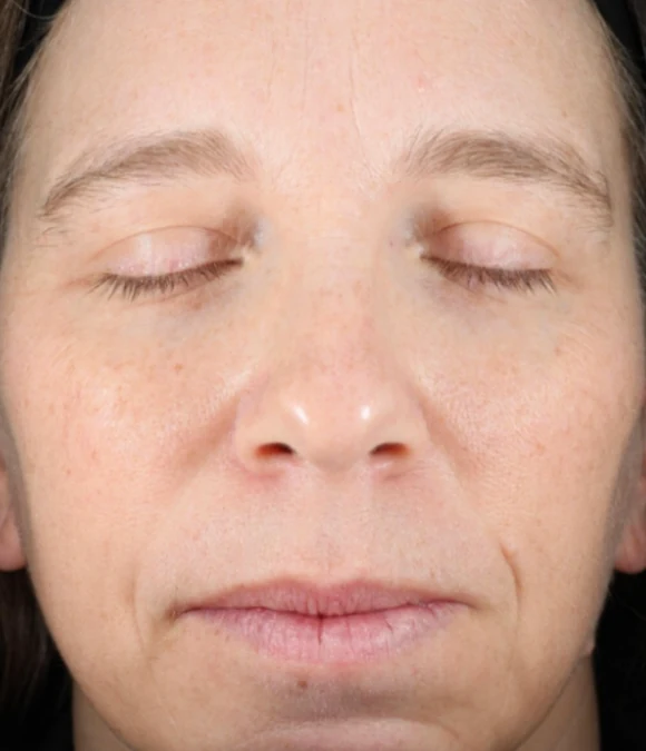 After 3 Ultra treatments — after