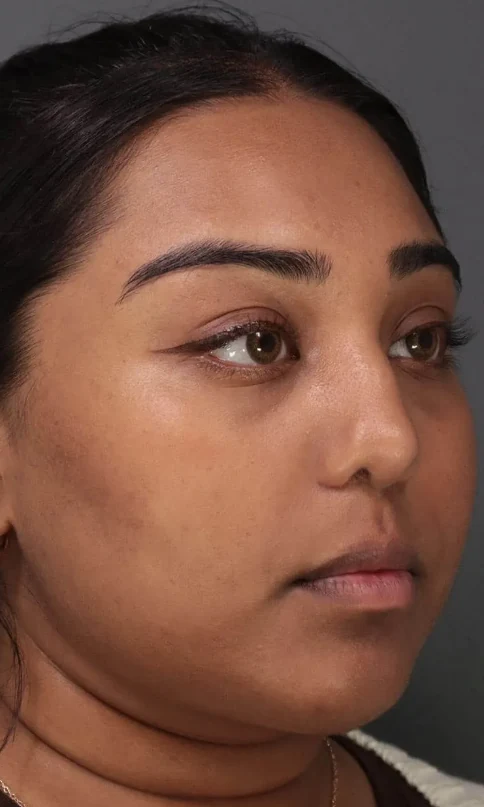 After 2 Ultra treatments — after