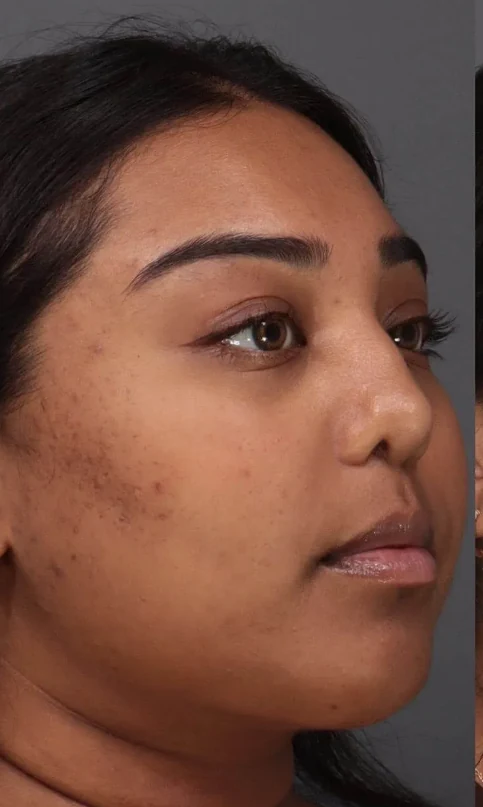 After 2 Ultra treatments — before