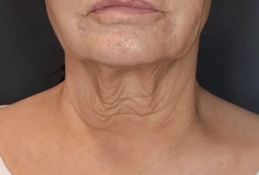 Neck — after 5 XERF treatments — before
