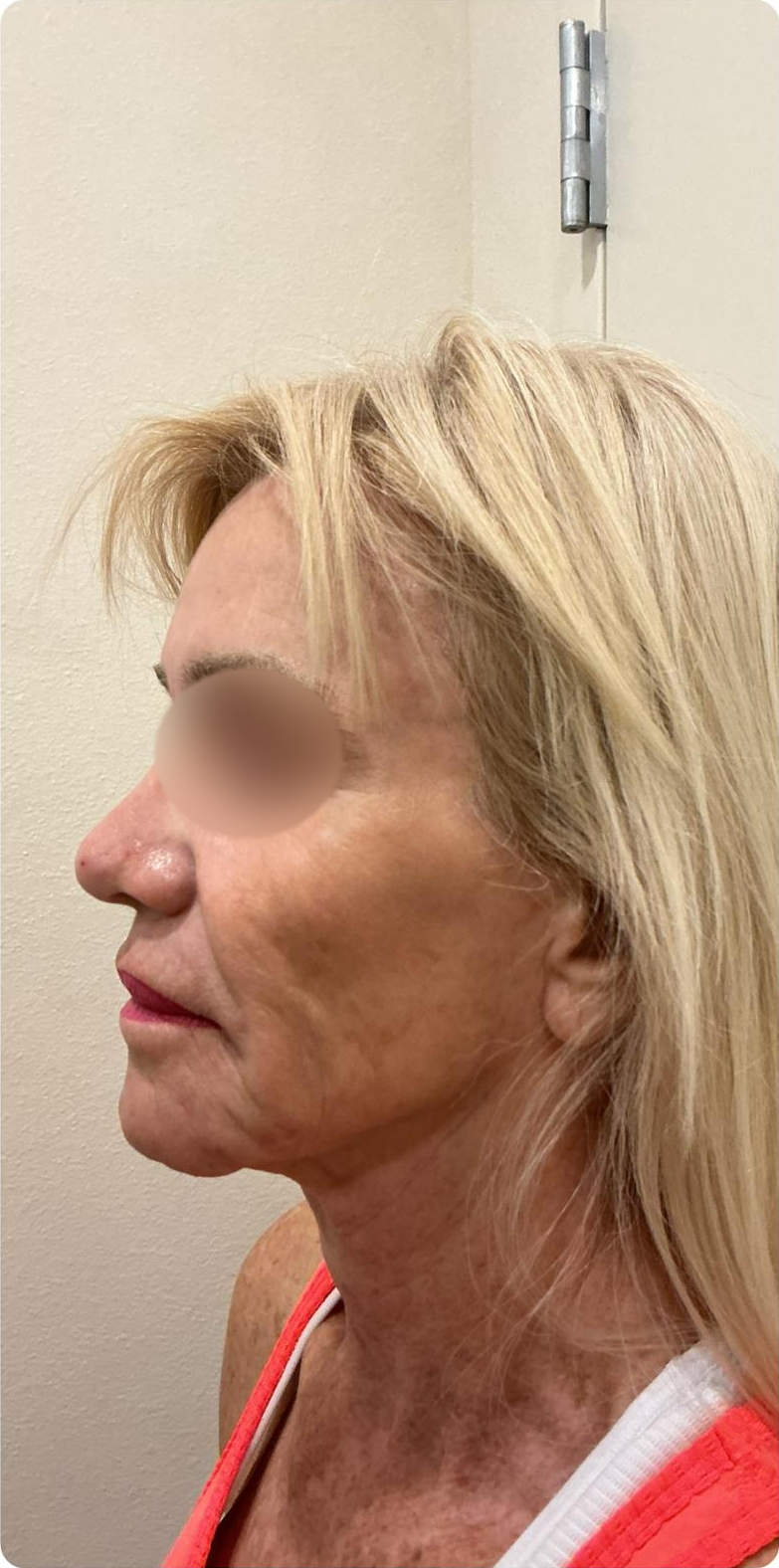 Supplied XERF photos — opposite profile. Eyes blurred for privacy. Individual results vary. — after