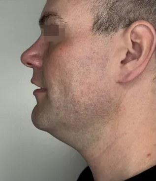 Jawline — after 2 XERF treatments — before