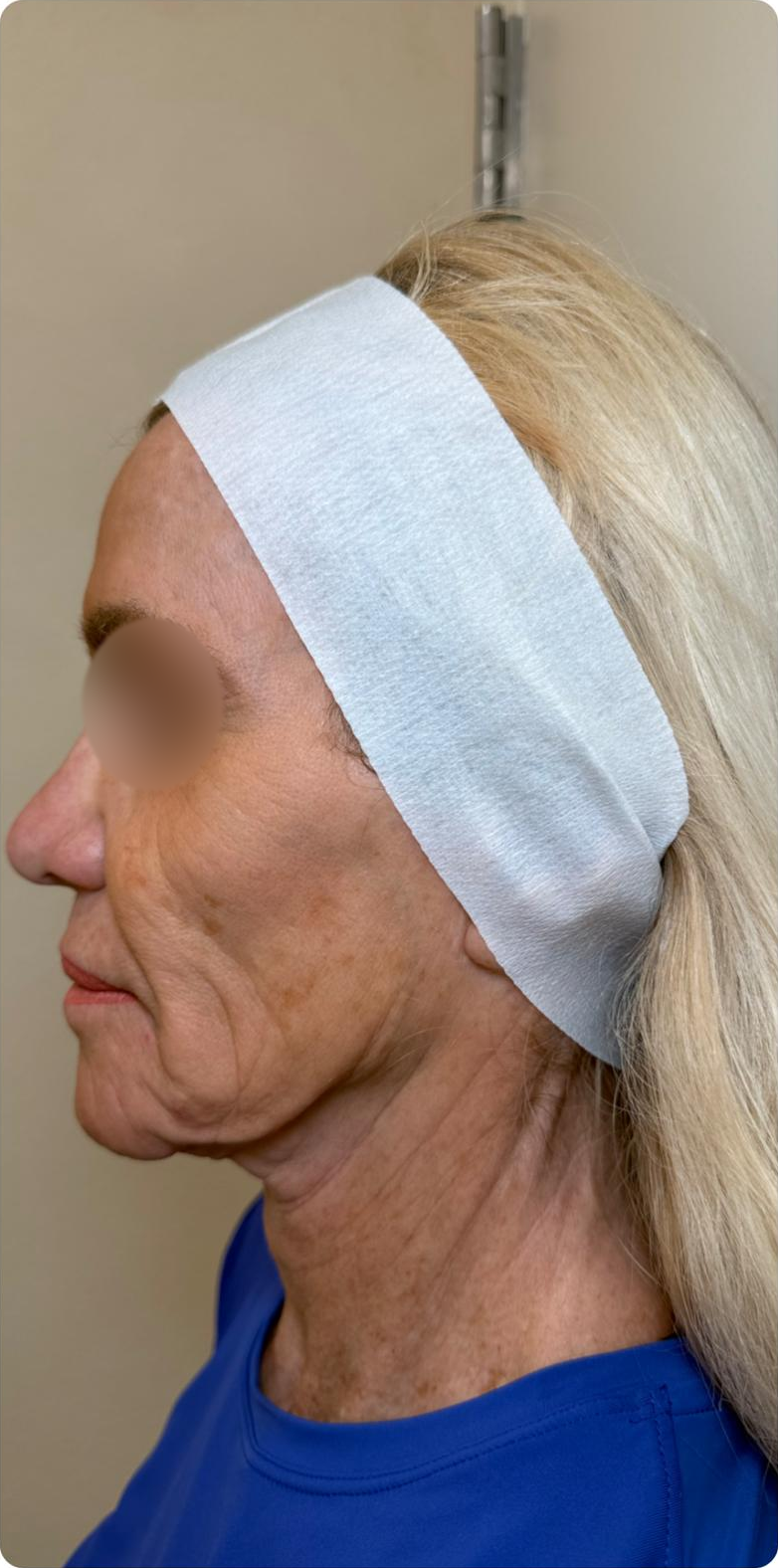 Supplied XERF photos — opposite profile. Eyes blurred for privacy. Individual results vary. — before