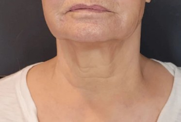 Neck — after 5 XERF treatments — after