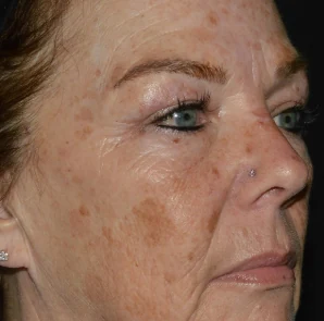 After 4 Ultra treatments — before