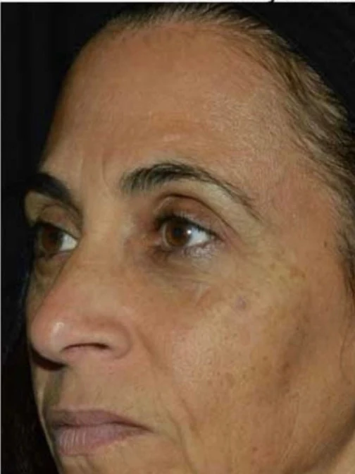 After 3 Ultra treatments — before