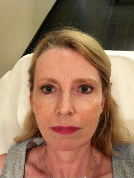 Supplied Lè Unique Ultra Laser photos. Individual results vary. — after