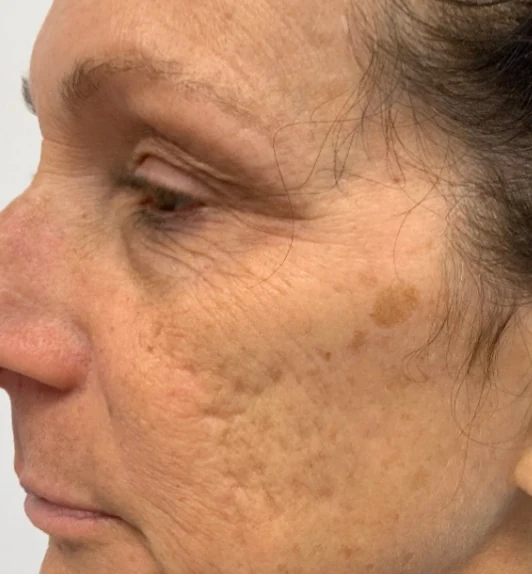 After 3 Ultra treatments — before