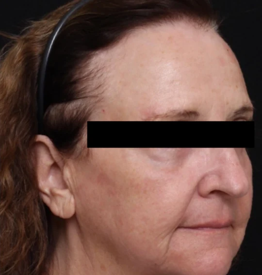 After 3 Ultra treatments — after